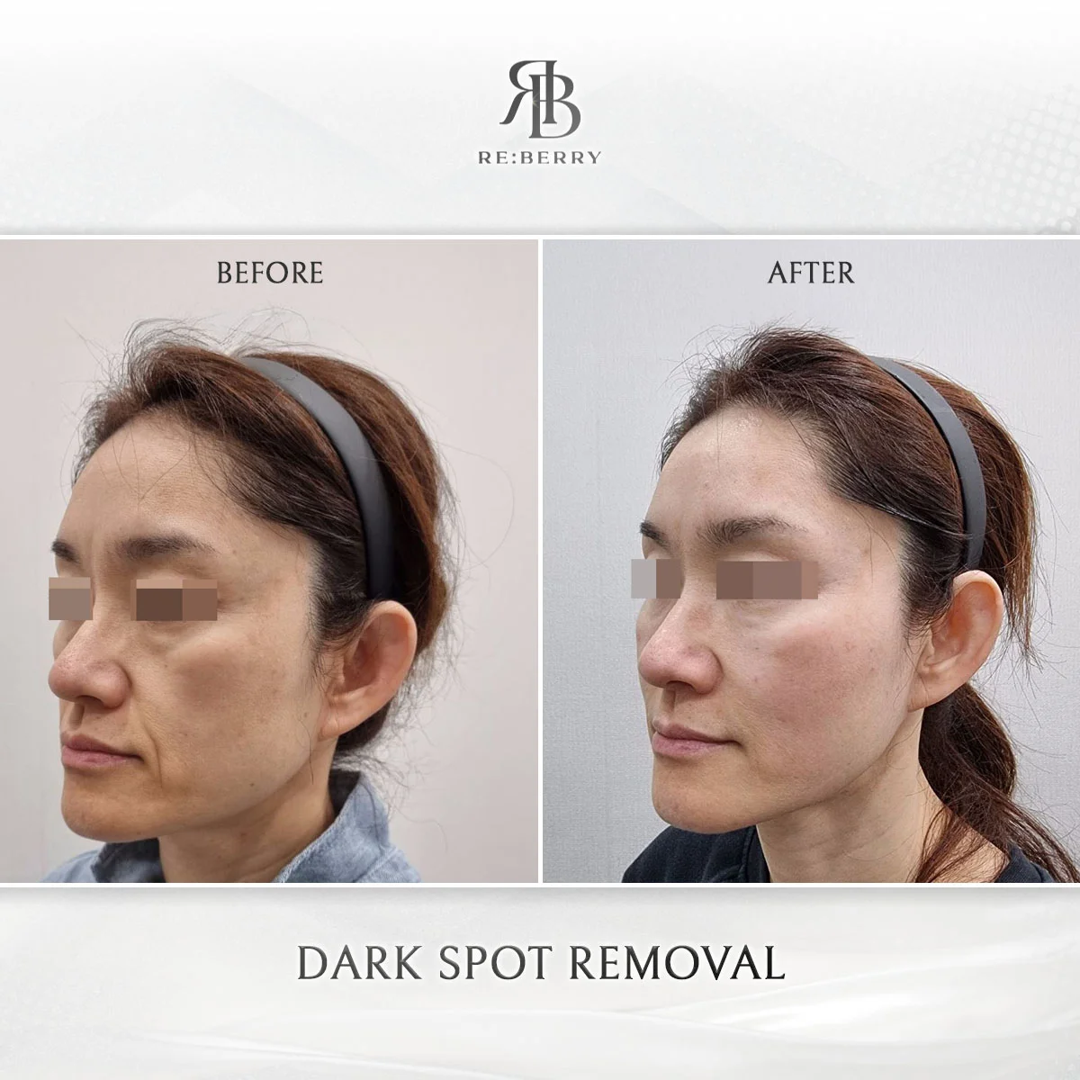 Age spot removal before after laser treatment Myeongdong Seoul
